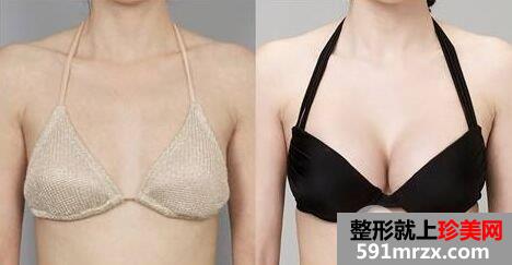 隆胸手术影响哺乳吗|隆胸前后对比照片