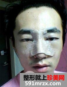 鹰钩鼻整形多少钱|鹰钩鼻矫正案例前后对比照片分享