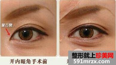 开眼角手术安全么|开眼角和不开的区别图