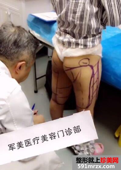 广州军美王世虎吸脂提臀术真实案例对比照片分享
