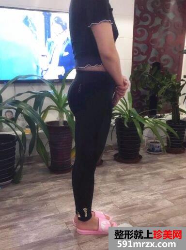 广州军美王世虎吸脂提臀术真实案例对比照片分享