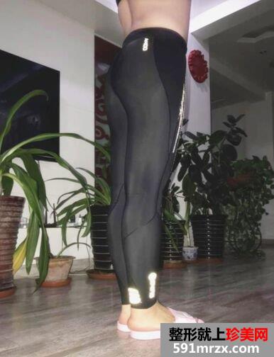 广州军美王世虎吸脂提臀术真实案例对比照片分享