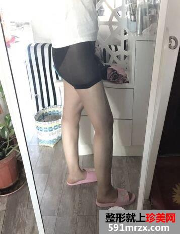 广州军美王世虎吸脂提臀术真实案例对比照片分享