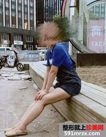 广州军美王世虎吸脂提臀术真实案例对比照片分享