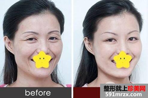 眼睛长细纹了怎么办|去眼纹的办法有哪些