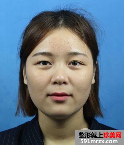 鼻子怎么变挺|长沙美莱鼻综合整形案例恢复效果分享