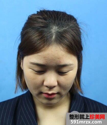 鼻子怎么变挺|长沙美莱鼻综合整形案例恢复效果分享