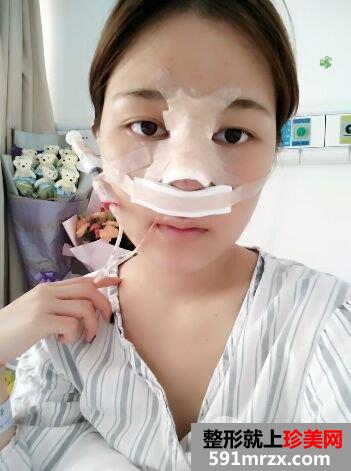 鼻子怎么变挺|长沙美莱鼻综合整形案例恢复效果分享