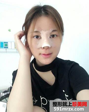 鼻子怎么变挺|长沙美莱鼻综合整形案例恢复效果分享