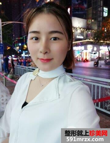 鼻子怎么变挺|长沙美莱鼻综合整形案例恢复效果分享