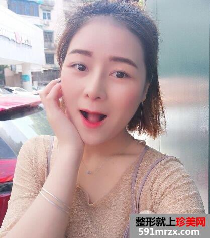鼻子怎么变挺|长沙美莱鼻综合整形案例恢复效果分享