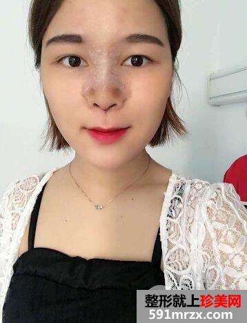 鼻子怎么变挺|长沙美莱鼻综合整形案例恢复效果分享