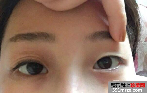 双眼皮手术恢复时间厦门华美全切双眼皮真实案例告诉你