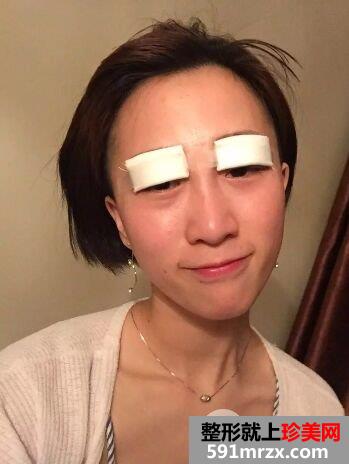 双眼皮手术恢复时间厦门华美全切双眼皮真实案例告诉你