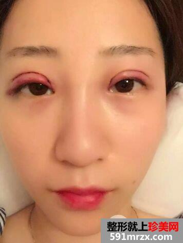 双眼皮手术恢复时间厦门华美全切双眼皮真实案例告诉你