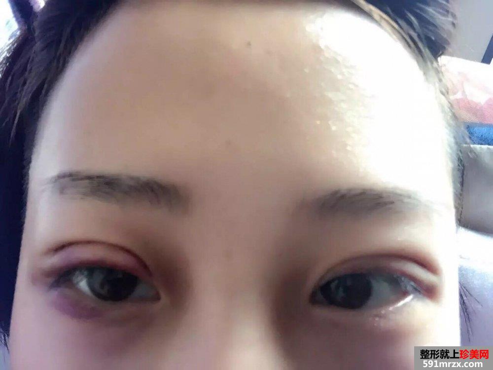 双眼皮手术恢复时间厦门华美全切双眼皮真实案例告诉你
