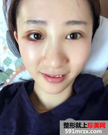 双眼皮手术恢复时间厦门华美全切双眼皮真实案例告诉你