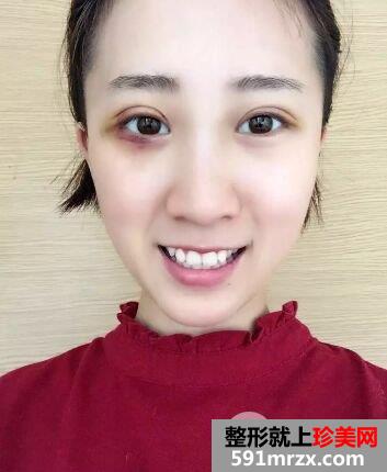双眼皮手术恢复时间厦门华美全切双眼皮真实案例告诉你