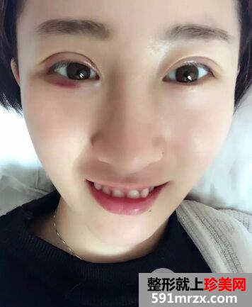 双眼皮手术恢复时间厦门华美全切双眼皮真实案例告诉你