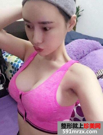 宁波江东壹加壹假体隆胸手术案例分享，还有更多效果图