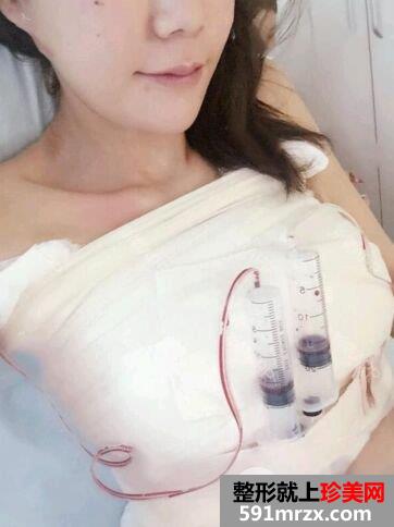 宁波江东壹加壹假体隆胸手术案例分享，还有更多效果图