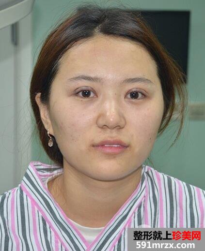 韩式三点双眼皮手术效果图北京聚美仕真实案例分享