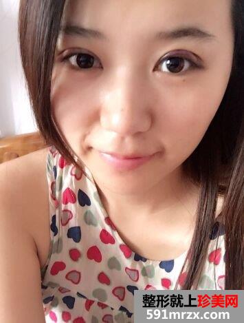 韩式三点双眼皮手术效果图北京聚美仕真实案例分享