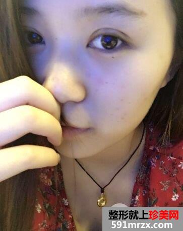 韩式三点双眼皮手术效果图北京聚美仕真实案例分享