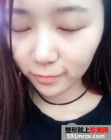 韩式三点双眼皮手术效果图北京聚美仕真实案例分享