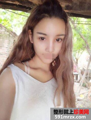 做双眼皮手术哪家好|上海光博士双眼皮整形案例效果分享