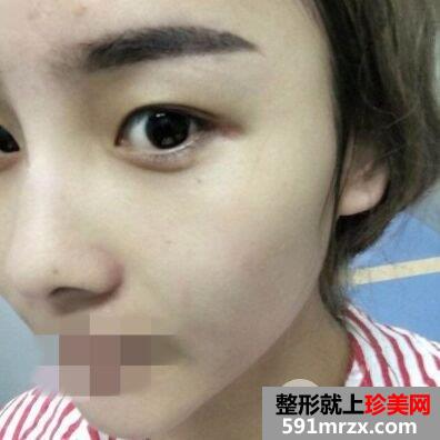 做双眼皮手术哪家好|上海光博士双眼皮整形案例效果分享