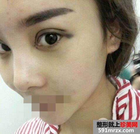做双眼皮手术哪家好|上海光博士双眼皮整形案例效果分享