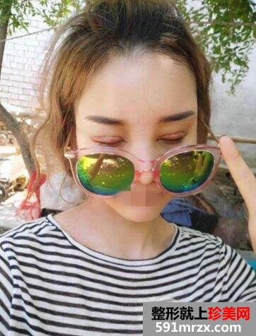 做双眼皮手术哪家好|上海光博士双眼皮整形案例效果分享
