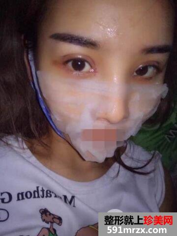 做双眼皮手术哪家好|上海光博士双眼皮整形案例效果分享