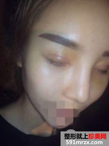 做双眼皮手术哪家好|上海光博士双眼皮整形案例效果分享