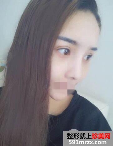 做双眼皮手术哪家好|上海光博士双眼皮整形案例效果分享