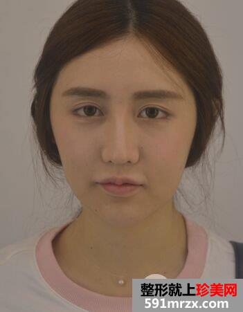 武汉洪山爱美汇面部吸脂真实案例，呈现小巧完美脸型