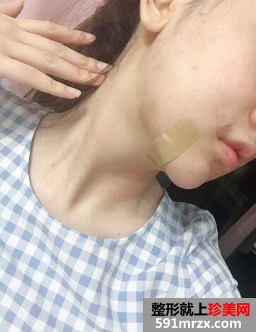 武汉洪山爱美汇面部吸脂真实案例，呈现小巧完美脸型