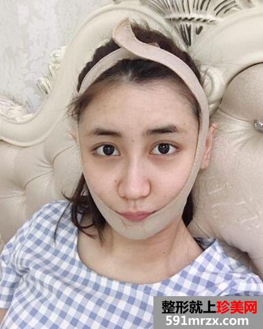 武汉洪山爱美汇面部吸脂真实案例，呈现小巧完美脸型