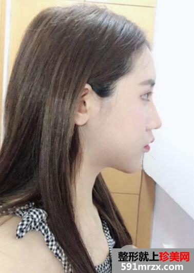 武汉洪山爱美汇面部吸脂真实案例，呈现小巧完美脸型