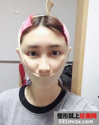武汉洪山爱美汇面部吸脂真实案例，呈现小巧完美脸型