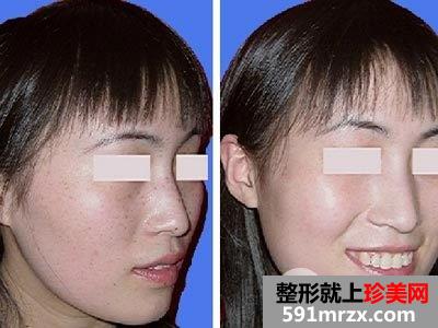 激光治疗祛斑后如何护理才能快速恢复