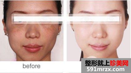 激光去黄褐斑对皮肤有伤害吗，有危害吗