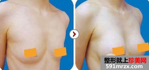 假体隆胸整形术后多久恢复、如何护理比较好