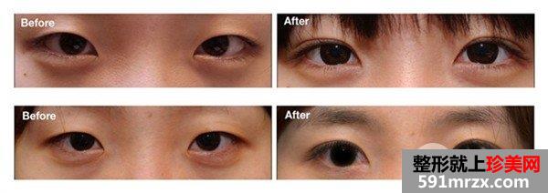 近视眼可以做双眼皮手术吗，会有影响吗