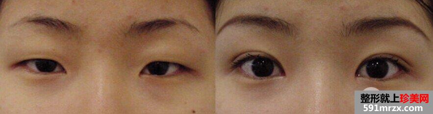 做双眼皮手术安全吗，有没有后遗症
