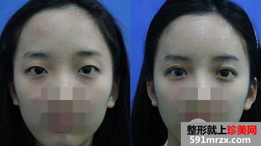 做完双眼皮术后效果不明显怎么办，可以重做吗