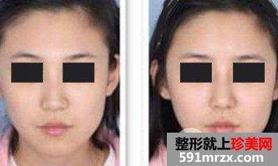 如何选择适合的隆鼻整形方法，哪种方法才能让你得到美丽鼻型