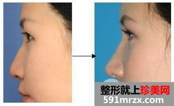 隆鼻术前要做什么准备，术后有哪些注意事项