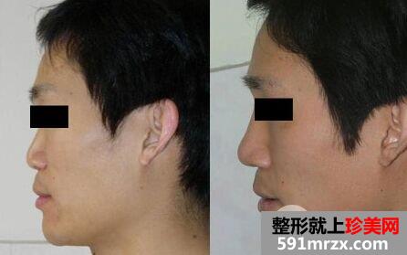 膨体隆鼻整形术后多久可以恢复自然